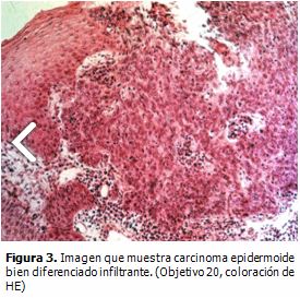 IMAGEN CARCINOMA EPIDERMOIDE BOCA imagen carcinoma epidermoide boca: